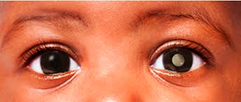 retinoblastoma