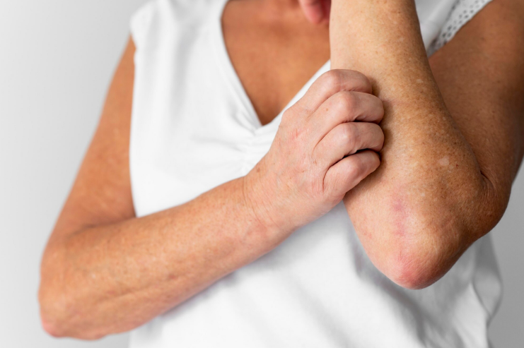 ASBAI-PR solicita inclusão de tratamento avançado para adultos com dermatite atópica no SUS